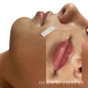 Dermal Fillers